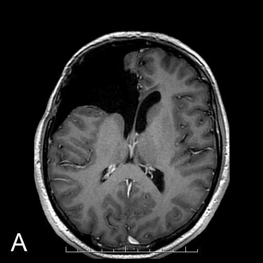 Fig.2.8. Post-surgical corpus callosum defect in a 39-year-old man after anaplastic astrocytoma surgery 4 years ago, followed by radiation and chemotherapy. A.