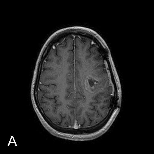 Fig.2.9. Acute radiation injury in a 44-year-old woman 2 months after anaplastic astrocytoma resection followed by radiotherapy. A. Axial T1 post-contrast MRI demonstrates postoperative cavity in the left frontal parietal lobe with a rim of contrast enhancement.