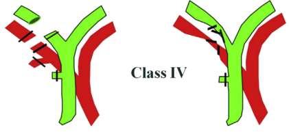 Class IV injuries Class IV injuries that do not include transection of the duct - managed nonoperatively Class