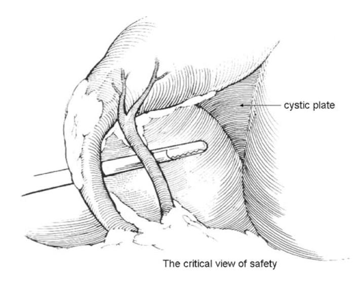 The Critical View of Safety Technique Calot s triangle dissected free of all tissue except for the