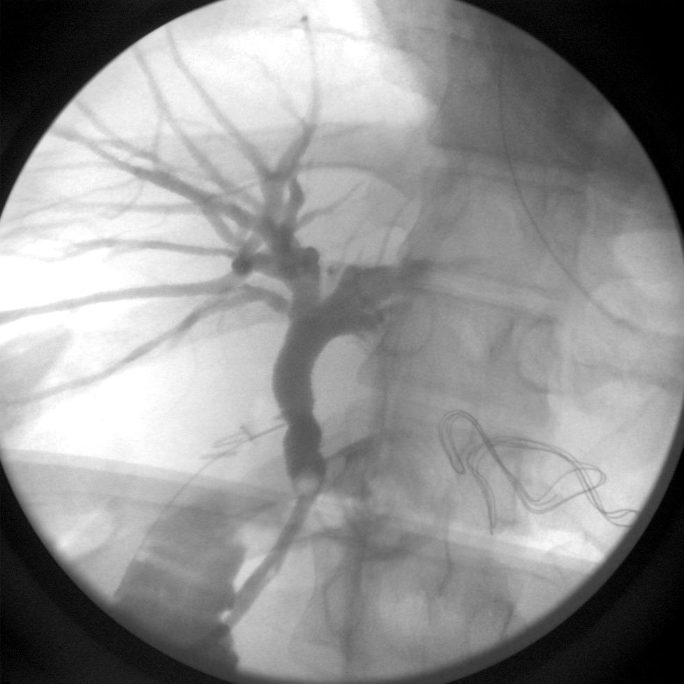 Role of Routine Intraoperative Cholangiography Pros Cons Decreases CBD injury Inexpensive Minimal