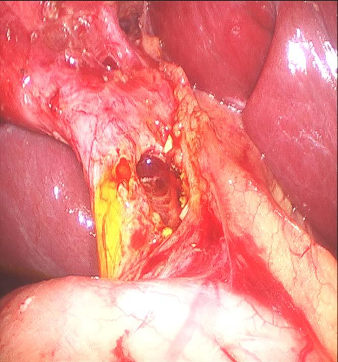 Is This Going to Happen to Me Laparoscopic Cholecystectomy 700,000 pts/year Pre-laparoscopic 0.2% in 42,000 0.3% in 25,500 Lap Chole 0.4 to 0.