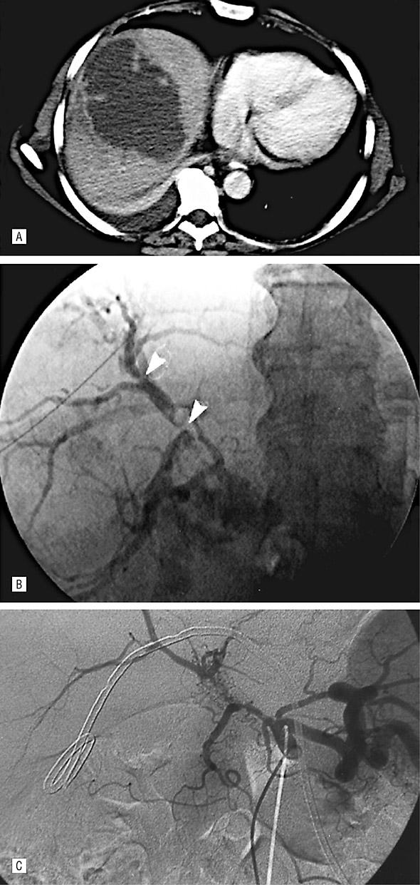 Combined CBD and Vascular Injury Open chole 7% R hepatic artery ligation on autopsy R