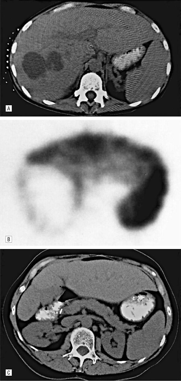 Management of the Combined CBD and Vascular Injury Identify injury Intra Op: doppler Post Op: CT Angiogram with biphasic contrast Intra