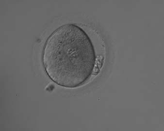 i32 Papale et al. Figure 125 Zygote with large-sized NPBs scattered with respect to the PN junction (400 magnification).
