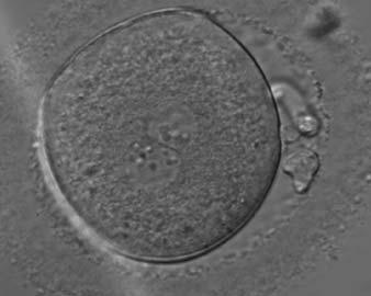 Figure 139 A zygote, generated by ICSI and observed 18 h postinsemination displaying centrally located PNs in which NPBs differ in number and size (400