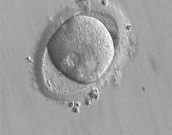 NPBs are small in size and scattered in both PNs. The derived embryo was highly fragmented with uneven blastomeres and was discarded.