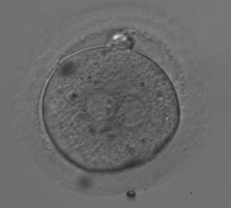 Figure 153 A zygote observed 18 h post-icsi with NPBs aligned at the PN junction (200 magnification). NPBs differ in number and size between PNs. The polar bodies are overlapped in this view.