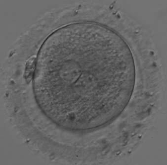 Figure 177 A zygote generated by ICSI displaying unequal number and size of NPBs between the PNs (400 magnification).