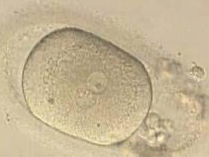 Figure 184 A zygote generated by ICSI showing what looks like two distinct PNs with distinct membranes and the absence of NPBs in one