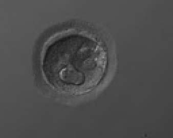 Polar bodies are fragmented and the ZP is of irregular thickness.  Figure 207 A zygote generated by ICSI showing cytoplasmic abnormalities (150 magnification).