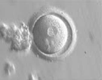 It was transferred but failed to implant. Figure 88 A zygote generated by ICSI with NPBs perfectly aligned at the junction of centrally located and juxtaposed PNs (600 magnification).