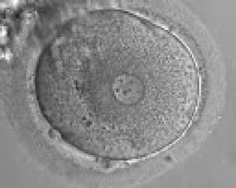 The resulting embryo was transferred, but failed to implant. Figure 93 A zygote generated by ICSI showing a single PN and two polar bodies separated by some distance (600 magnification). A.3 3PN The formation of triploid zygotes differs in origin, depending on whether they are generated by ICSI or IVF.