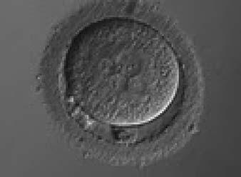 i26 Papale et al. Figure 97 A zygote with 5PNs, halo cytoplasm, fragmented polar bodies, oval shape and dark ZP (400 magnification). It was warmed after vitrification.