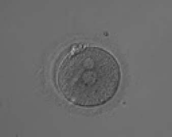 Figure 105 A zygote observed 18 h post-icsi displaying very unequal-sized juxtaposed PNs, with the smaller