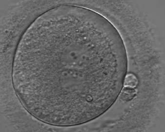 Large angles between polar bodies (Figs 122 124) have been suggested to be predictors of poor embryo development (Gianaroli et al., 2003).