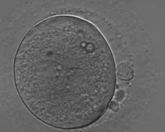 Figure 117 An ICSI zygote with large-sized NPBs aligned at the PN junction (400 magnification).