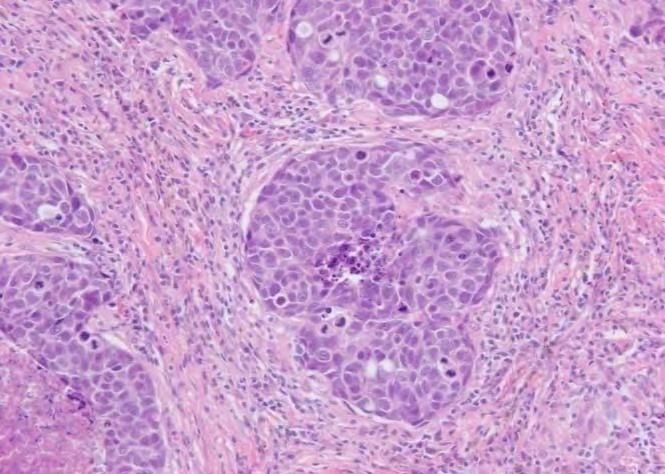 NSCLC large cell carcinoma Large cell carcinoma is an