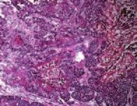 months; TM t 4 months) H&E E/DAPI td/dapi Mix Supplementry Figure 6 Shh-negtive cells in CIS lesion do not contribute to tumor-propgting cells in invsive crcinom.