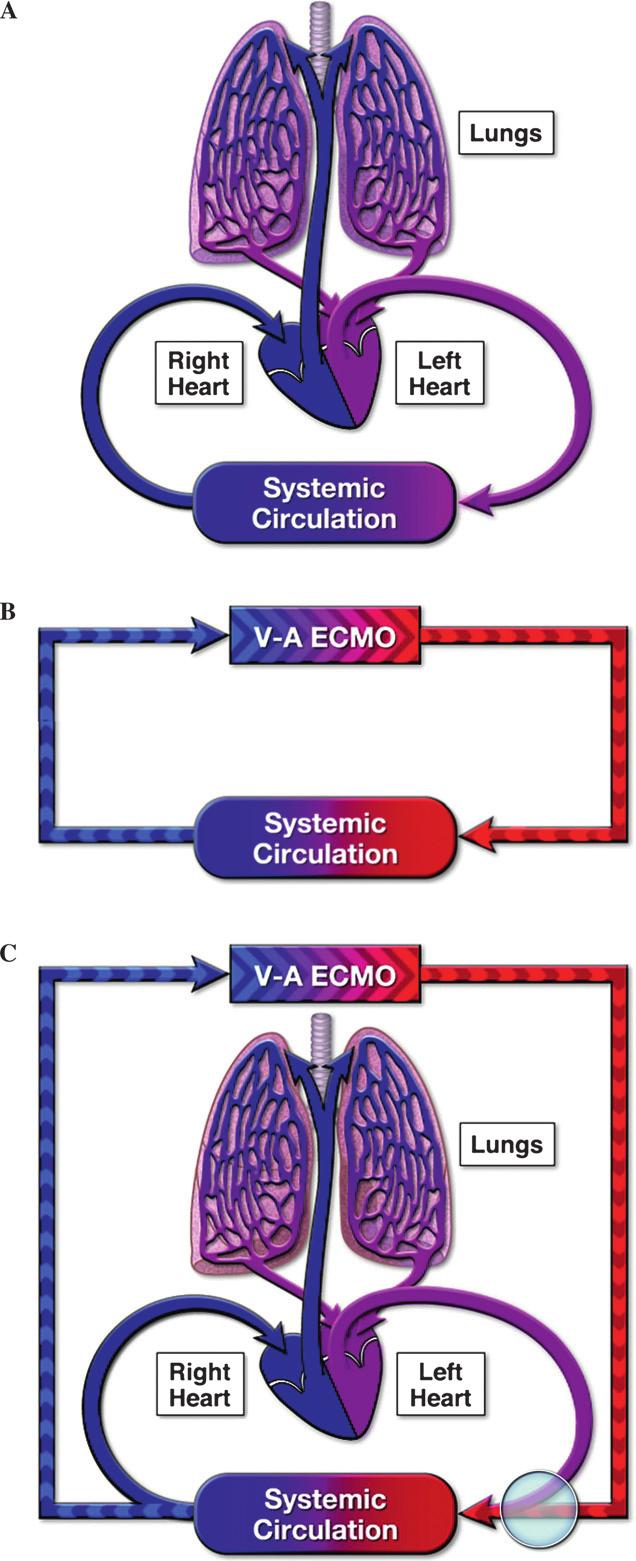REGIONAL PERFUSION DURING VENOARTERIAL ECMO 191 extremities will be pink.