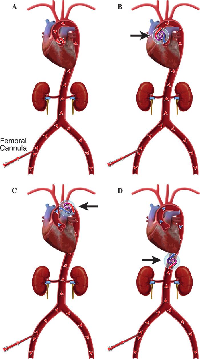 REGIONAL PERFUSION DURING VENOARTERIAL ECMO 193 support (Figure 4A).