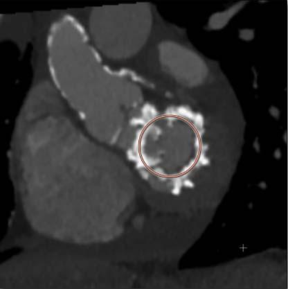 CARDIAC CT Retrospectively EKG gated with contrast JACC CV Imag 2016;9:1318 number 25 Am J Card