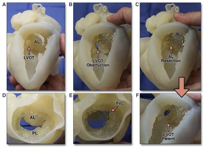 3D Printing for Procedural Simulation JACC CV Imag 2016;9:1318 number 27 IMPORTANT CLINICAL ISSUES related to MAC Associated with gradient complicating valve surgical planning-possibly symptomatic