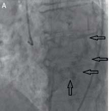 A 79 yo male presents for a TAVR evaluation.