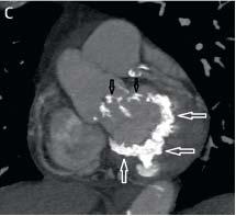Survival in such patients with degenerative calcific mitral stenosis is: 1.