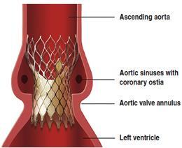 aortic annulus Medtronic CoreValve