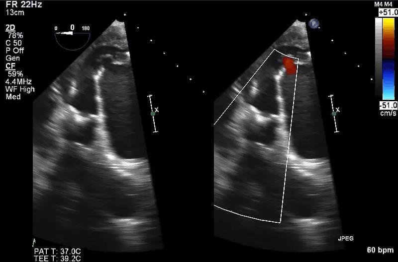 SEVERE AORTIC STENOSIS TEE: Transgastric View