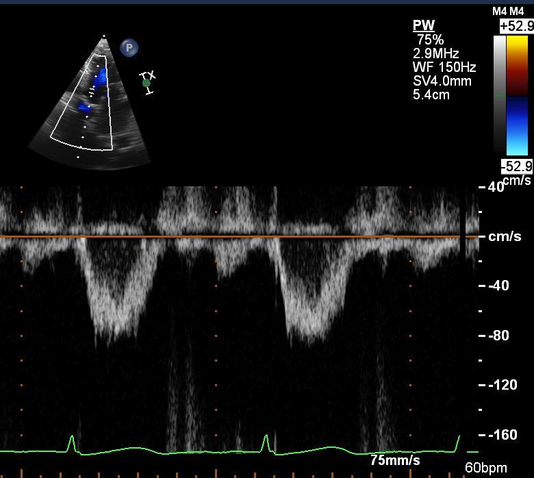 SEVERE AORTIC STENOSIS Continuous Wave (CW) Doppler Pulsed Wave (PW) Doppler AORTIC VALVE VTI = 134 cm Vmax = 4.