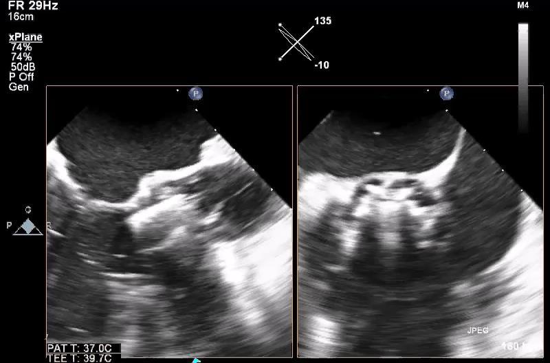 SEVERE AORTIC STENOSIS