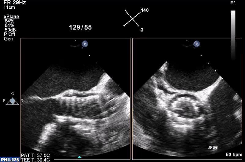 SEVERE AORTIC STENOSIS TREATED WITH COREVALVE