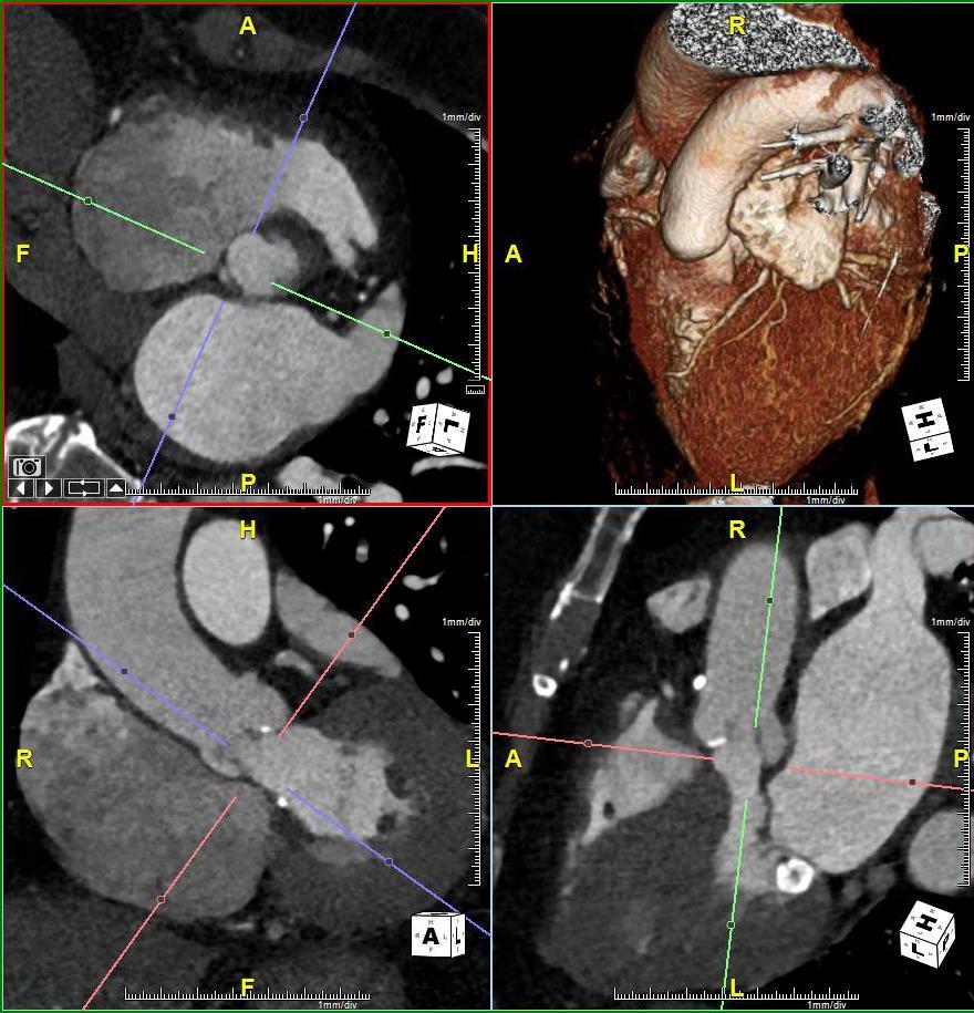 AORTIC ANNULAR SIZING CT