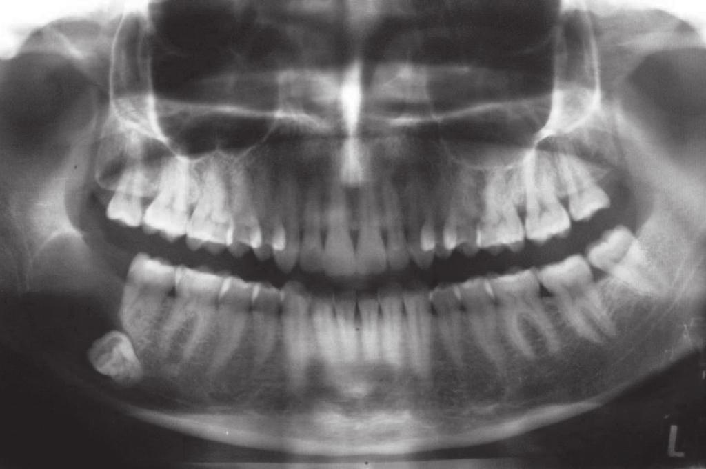 51 FIGURE 1 Preoperative panoramic radiograph which shows unilocular radiolucency and impacted tooth on the right posterior mandibular region term follow-up period was planned.