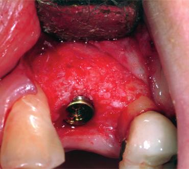 Granules (2-4 mm) Patient s initial