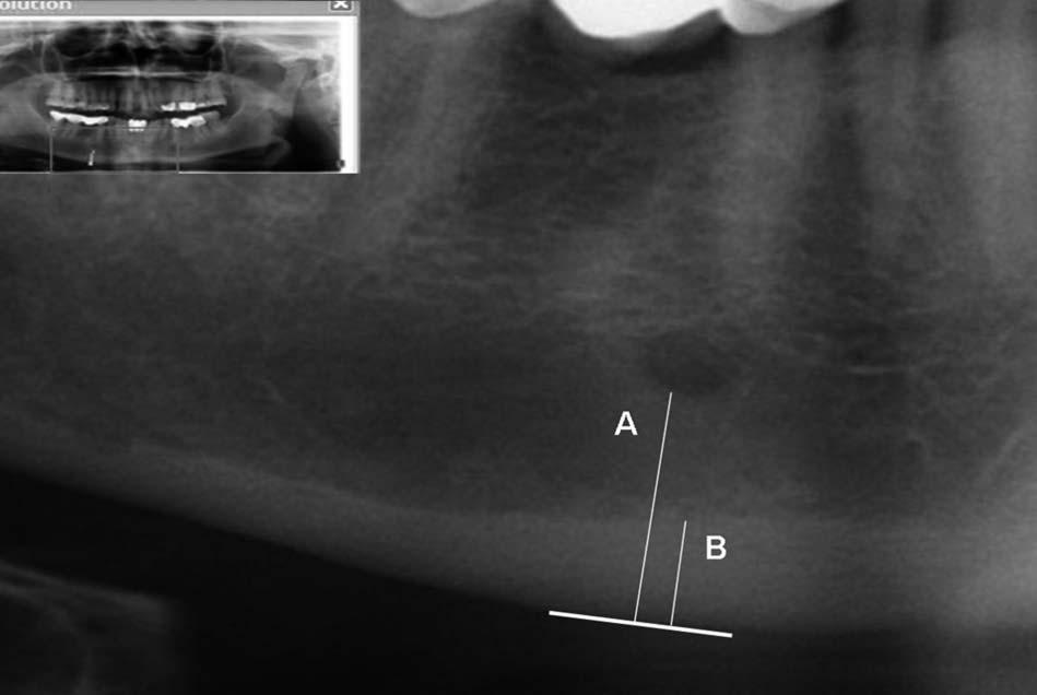 Mansour et al Imaging Software KDIS ) after correcting the magnification factor. AU1 FIGURE 1. A cropped digital panoramic radiograph showing measurement lines.