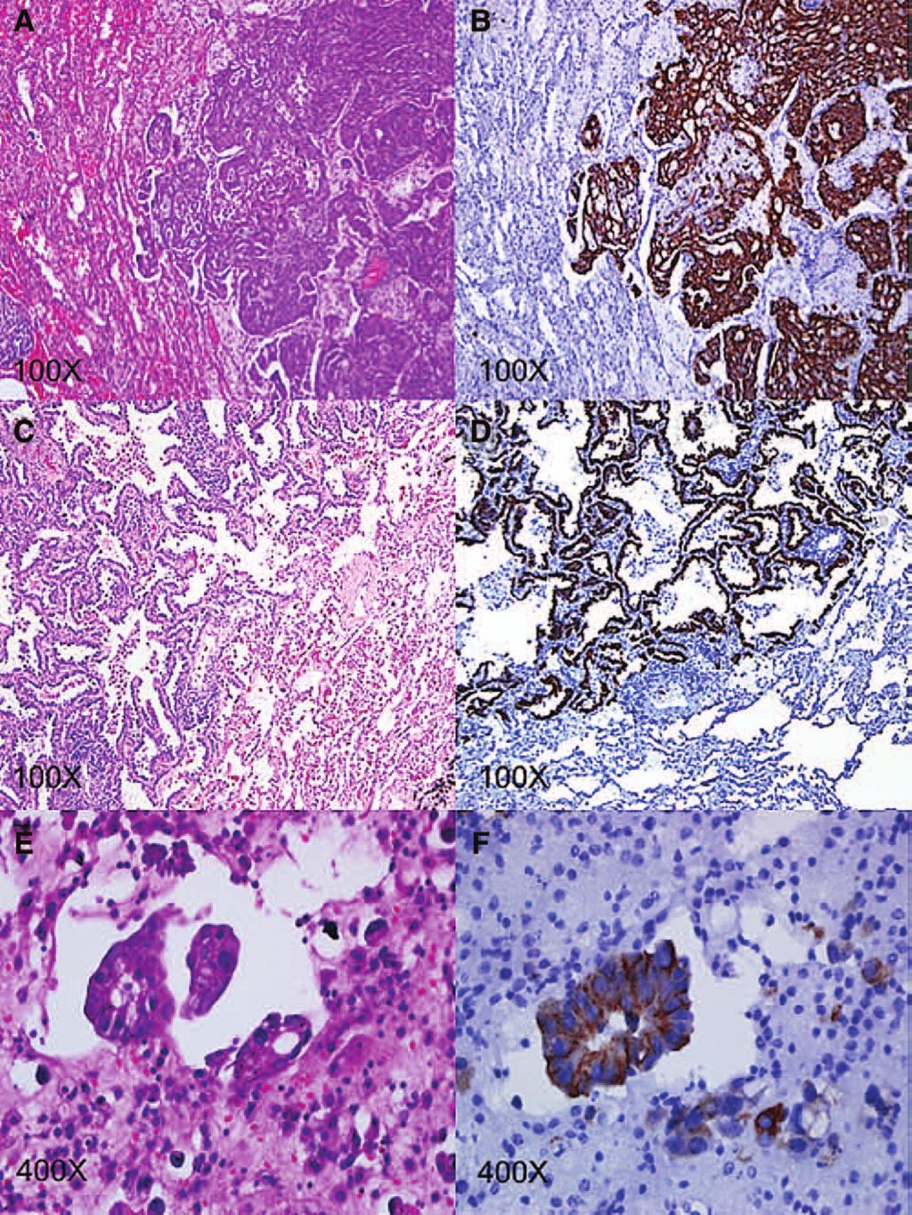 Journal of Thoracic Oncology Volume 9, Number 8, August 2014 Lung Adenocarcinoma Patients with ROS1 Fusion FIGURE 1.