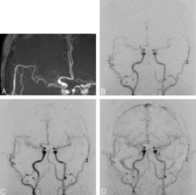 AJNR: 26, October 2005 ASSESSMENT OF EXTRACRANIAL-INTRACRANIAL BYPASS 2245 FIG 1. A 57-year-old man 7 months after STA-MCA anastomosis for stenosis of the right MCA.