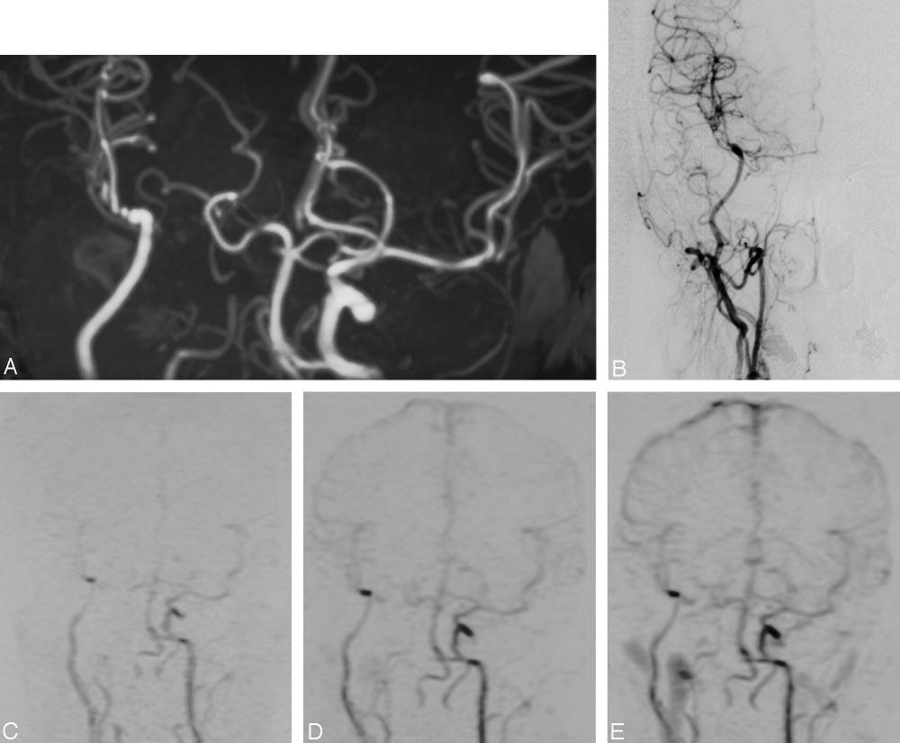 2246 TSUCHIYA AJNR: 26, October 2005 FIG 2. A 43-year-old woman 3 weeks after EC-MCA anastomosis by using a radial-artery graft for occlusion of the right ICA for treatment of a large ICA aneurysm.