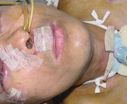 From the contralateral nostril the fine bore feeding tube that will be used for enteral nutrition in the postoperative period is seen, as is the foley catheter whose cuff is inflated with sterile