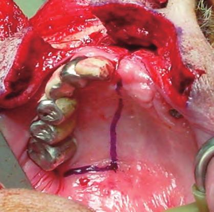 Use a tonsil or Ferguson Auckland mouth gag to open the mouth and retract the tongue to visualize the hard and soft palates. Figure 1 The skin incisions for the maxillary swing approach.