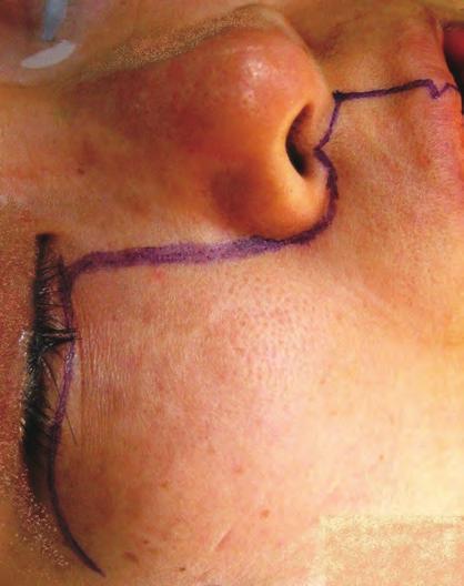 A notch is marked in the nasal vestibule and at the vermillion border On the hard palate mucosa a paramedian or parasagittal incision is marked 7 mm from the midline on the side of the swing.