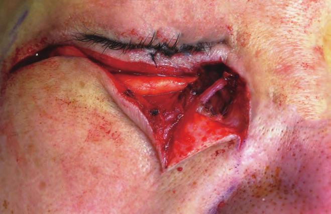 vessel encountered in the facial incision