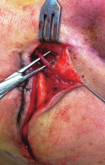 musculocutaneous flap is elevated off the inferior
