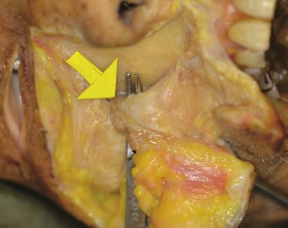 periosteum incised on the anterior aspect of the inferior