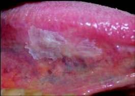 diagnosis, as seemingly benign lesions may still pose a risk. Mucosal lesions can be predominantly white or red and have variable thickness and texture.