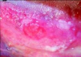 diffuse] and texture [smooth, flat, raised, dome shaped; granular, verrucous, ulcerated, indurated]. Figure 5 is an example of a lesion at the left labial commissure.