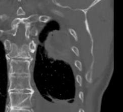 mutation Extensive refractory NSCLC with metastases to the